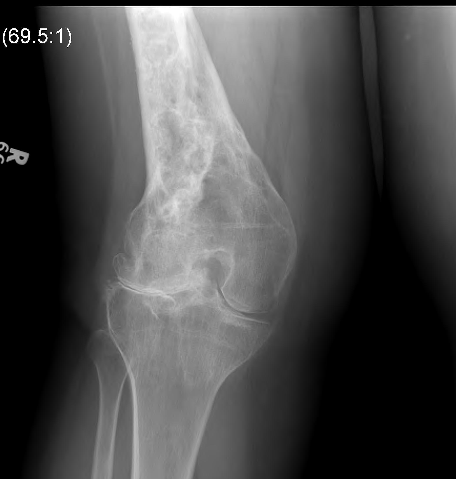 Previous Unicondylar Fracture 2